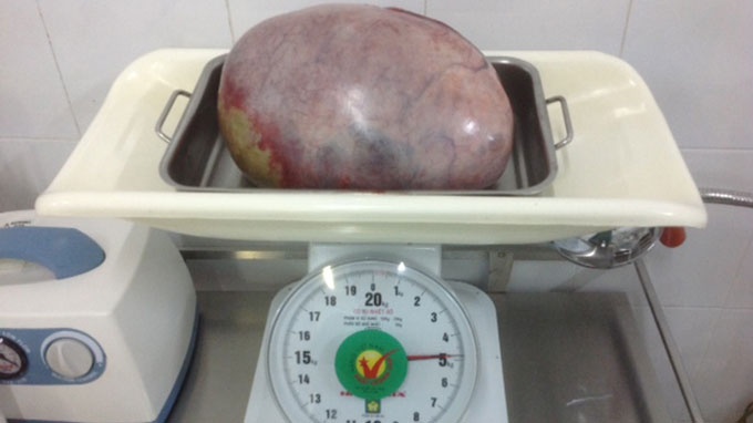 Thieu nu chua chong bi khoi u buong trung 5 kg hinh anh