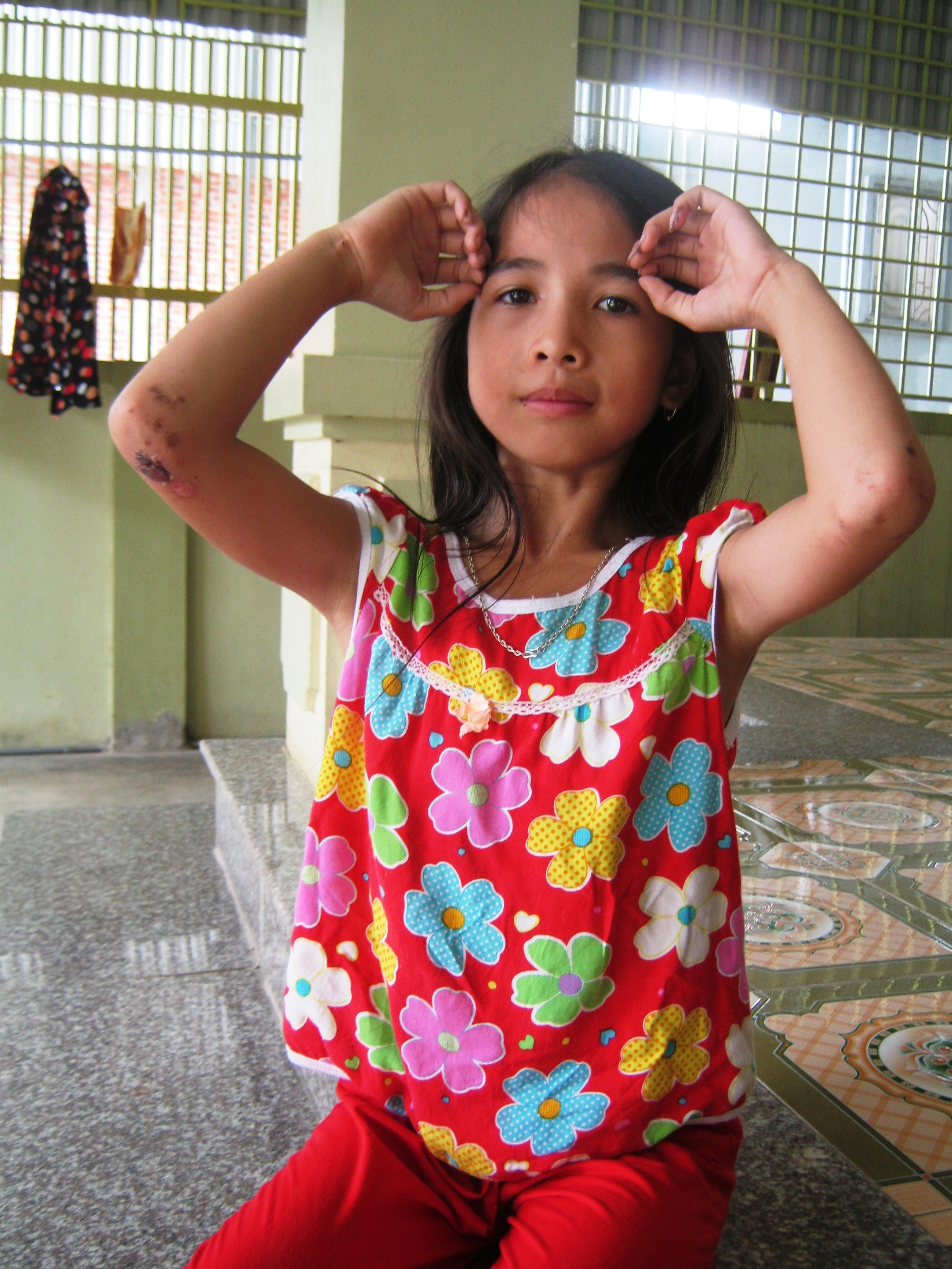 Vết trầy xước trên thân thể cháu Thuy sau 2 giờ vật lộn dưới giếng để dành sự sống.