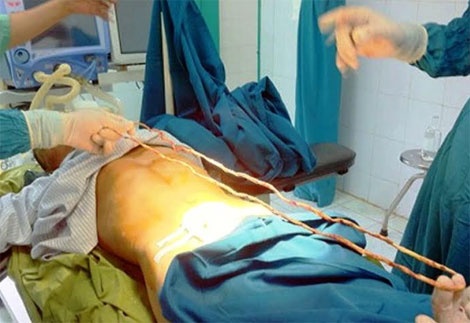 Day truyen dich 1,4 m nam trong... bang quang hinh anh