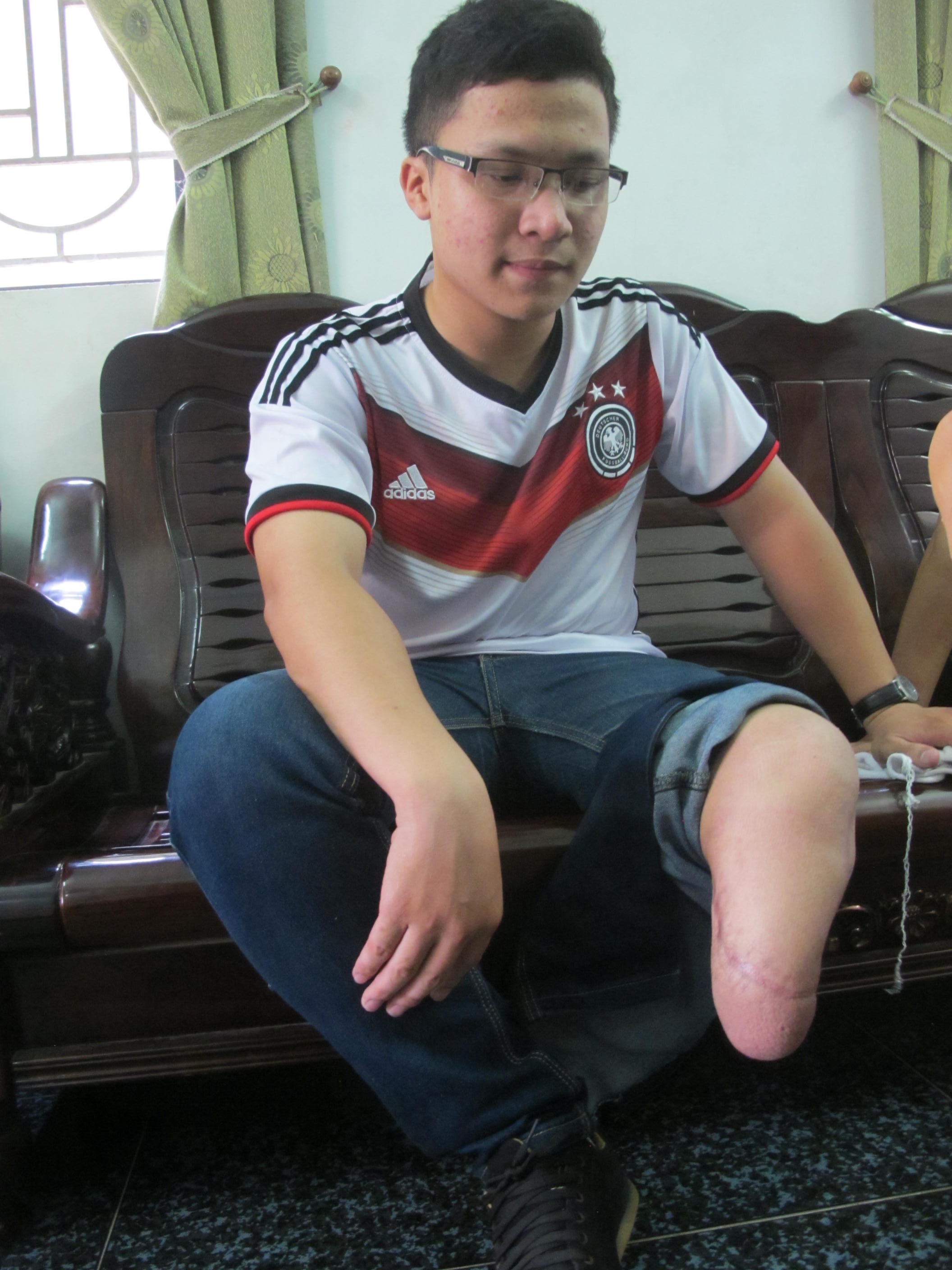 Thức với đôi chân bị cưa mất 2/3. cẳng chân.