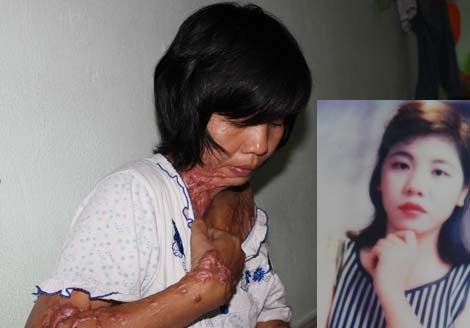 Loi keu cuu xot xa cua mot nan nhan bi tat axit hinh anh