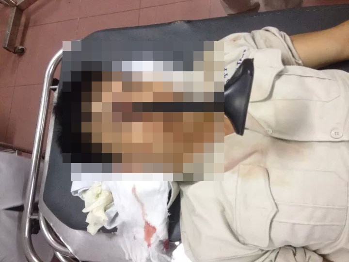 Nam thanh niên nhập viện với chiếc cán gương ô tô đâm xuyên mắt.