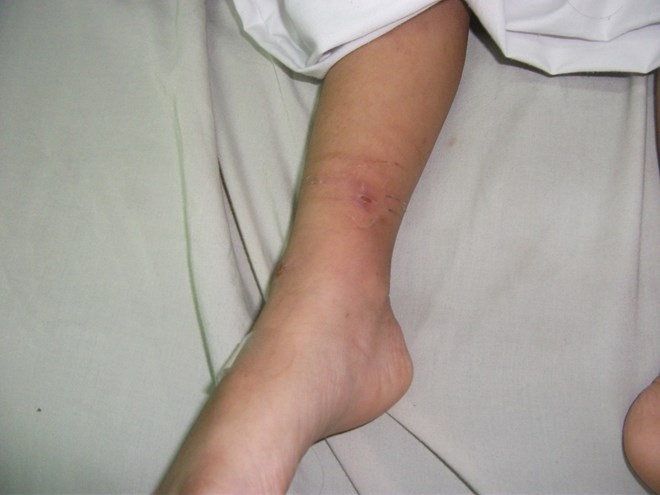 Vết thương ở cổ chân bé nghi bị cột dây thừng.