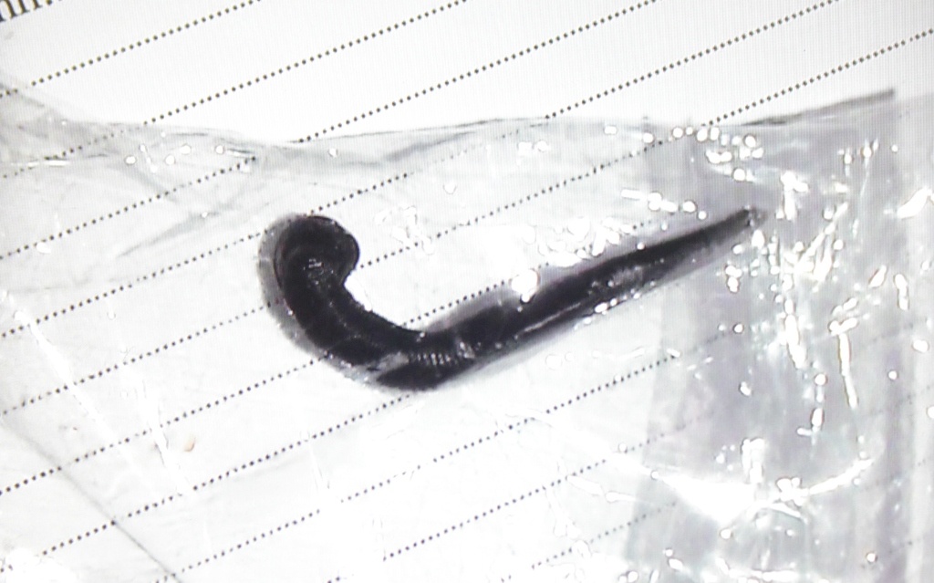 Dia song ky sinh hon 1 thang trong thanh quan benh nhi 11 tuoi hinh anh