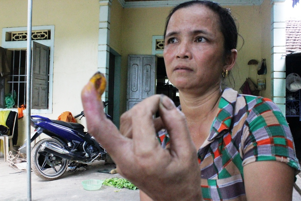 Chị Nguyễn Thị Thành và ngón tay bị rắn lục đuôi đỏ cắn cách đây 1 tháng vẫn chưa khỏi