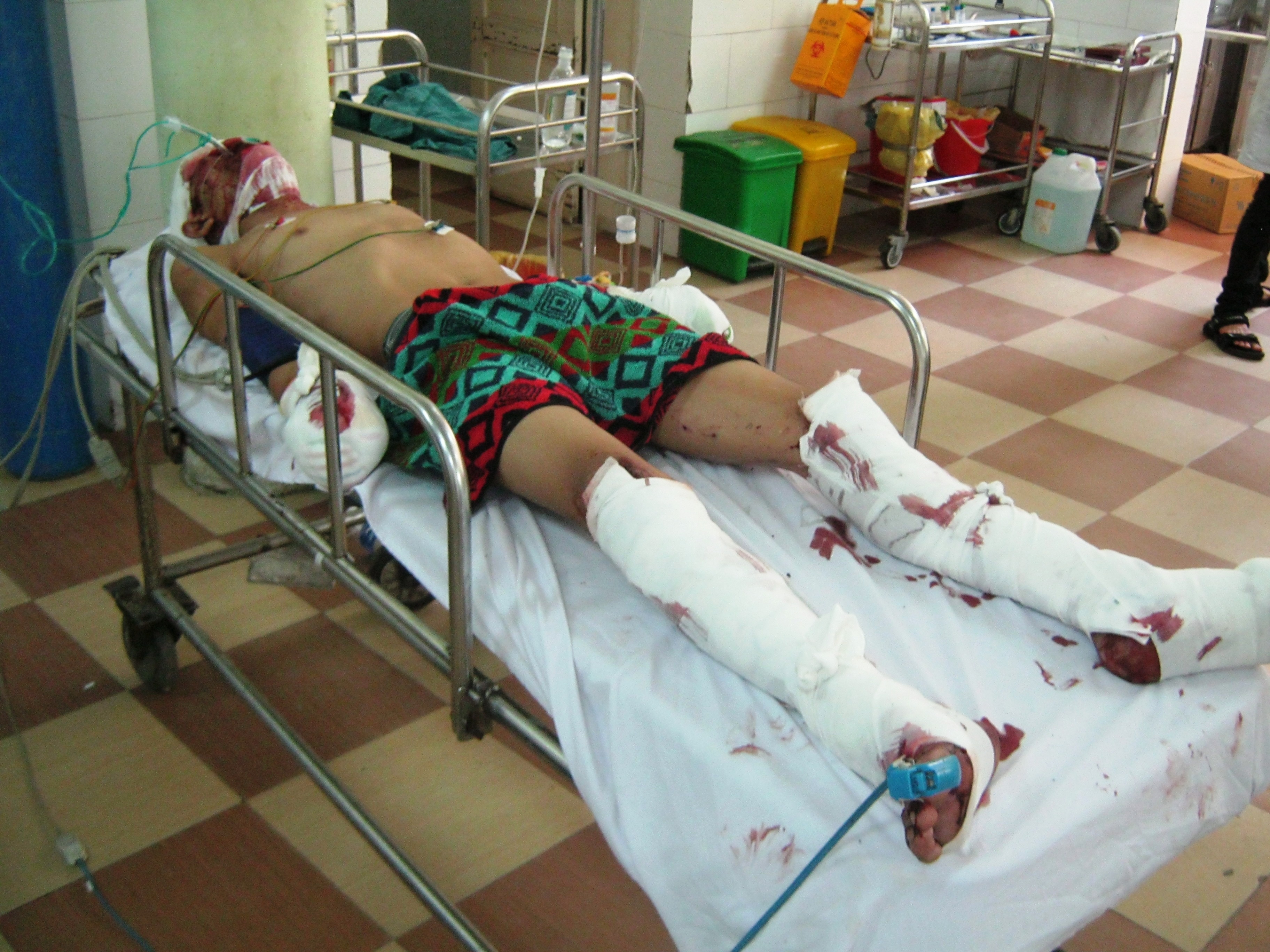 Vụ nổ làm 3 người trên xe khách bị thương nặng, Hiện còn một người vẫn đang phải nằm viện.