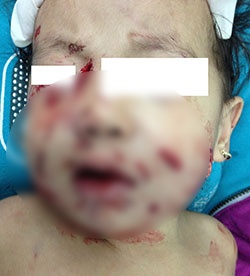 Hình ảnh thương tâm bé gái bị chó nhà cắn.