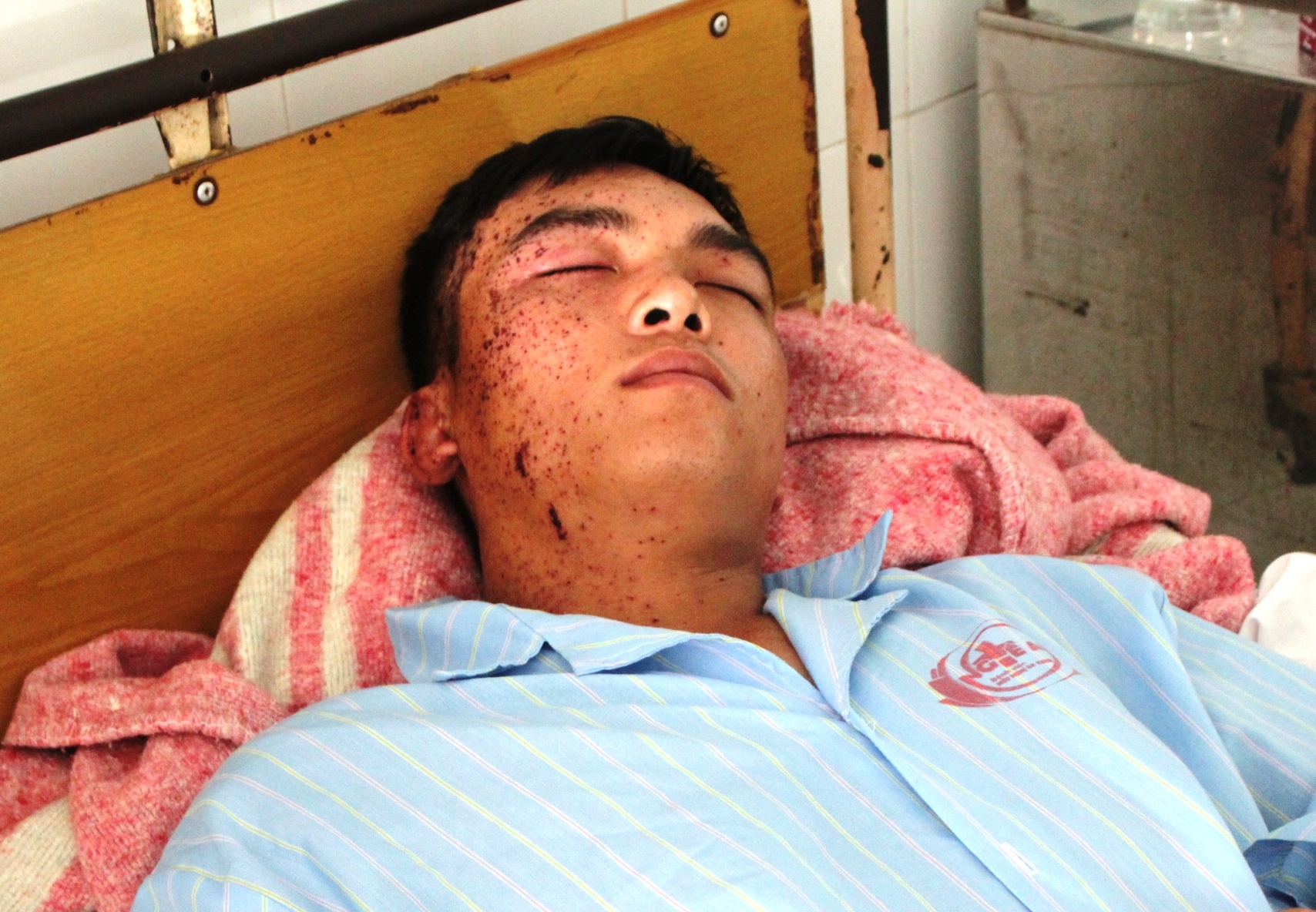 Vết thương chi chít trên mặt anh Sơn. Hiên anh và em gái đang điều trị tại Bệnh viện đa khoa tỉnh Nghệ An. Ảnh: PH.