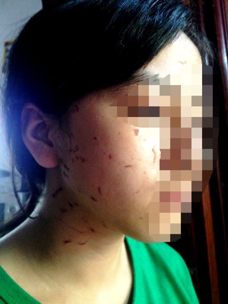 Gương mặt nữ sinh Lan bị nhiều vết sẻo do bị đánh. Ảnh: ND.