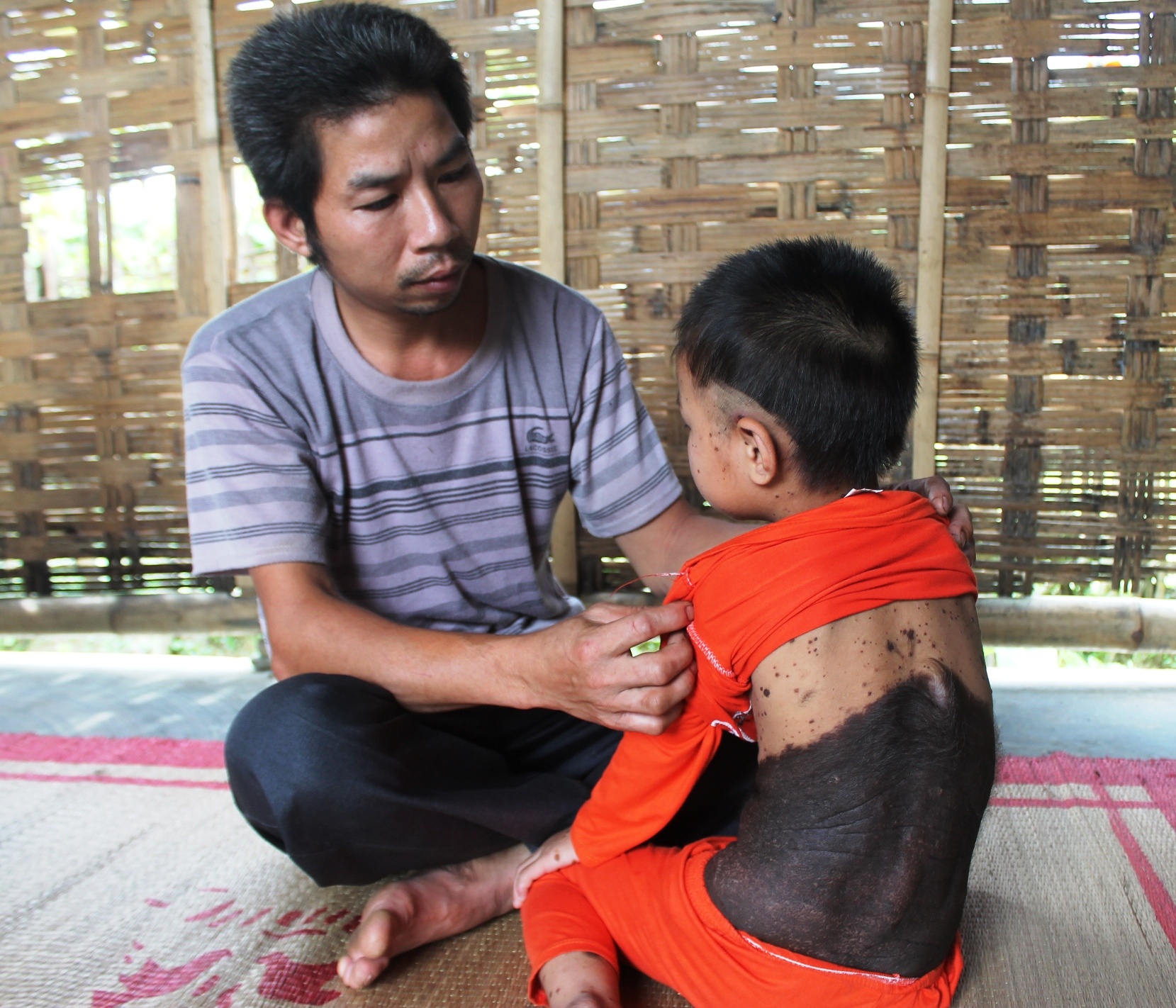 Chau be 5 tuoi da den sam, long moc khap nguoi hinh anh