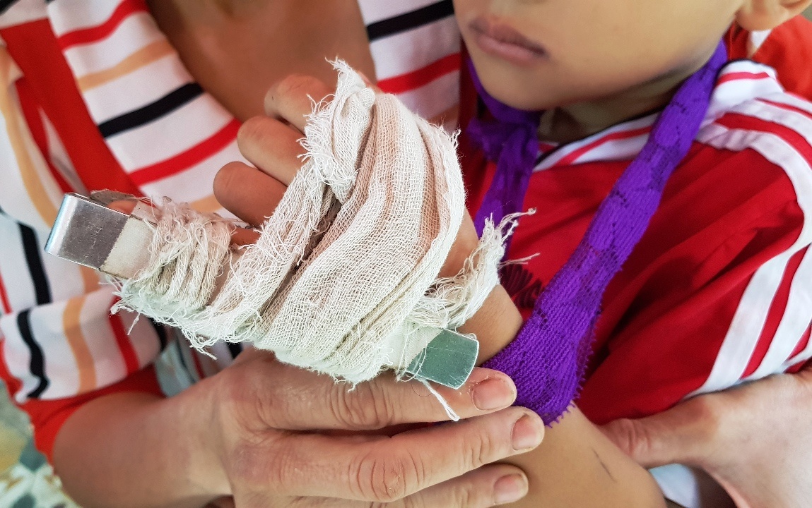 Giao vien mam non bi to danh be trai 5 tuoi gay ngon tay hinh anh