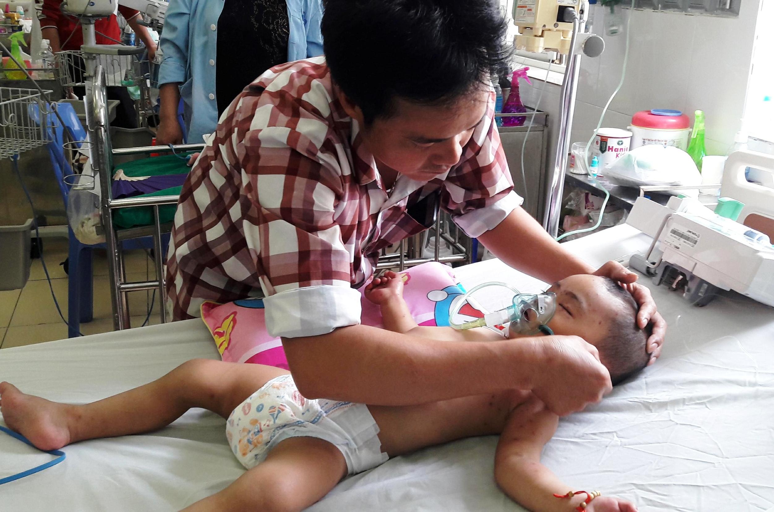 Be trai 19 thang tuoi bi hang tram vet ong dot hinh anh