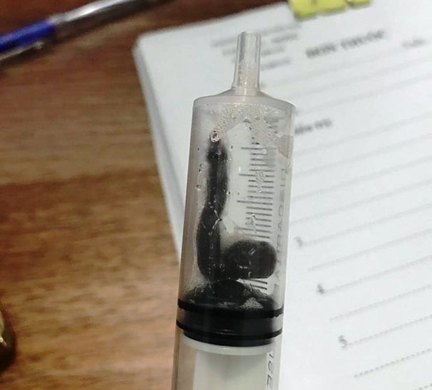 Con vat dai 7 cm song ky sinh trong mui benh nhan hinh anh