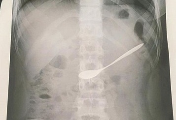 Nuot chiec thia vao bung khi uong ca phe, co gai 20 tuoi nhap vien hinh anh