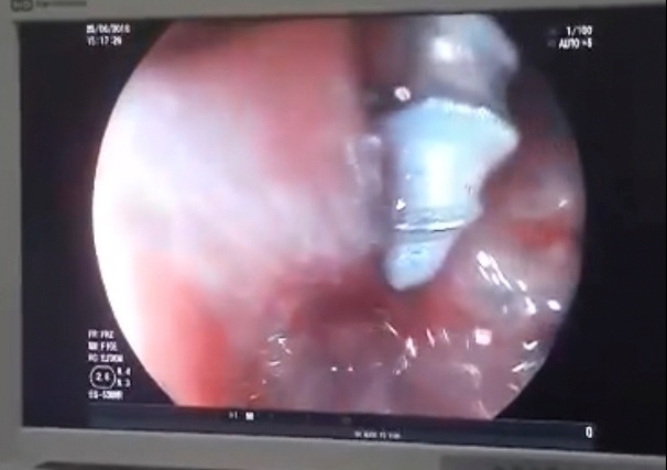 Be gai 2 tuoi nuot oc vit vao bung hinh anh