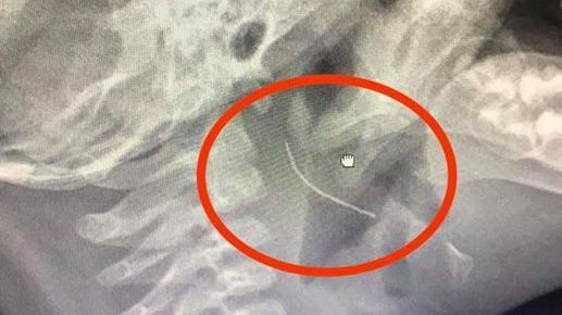 Gap manh thep 2 cm cam vao thanh hong be trai 13 thang tuoi hinh anh