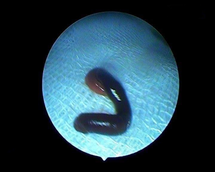 dia suoi dai 5 cm trong hoc mui anh 1