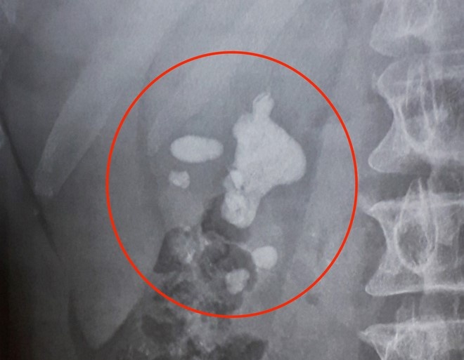 soi trong bung benh nhan anh 1