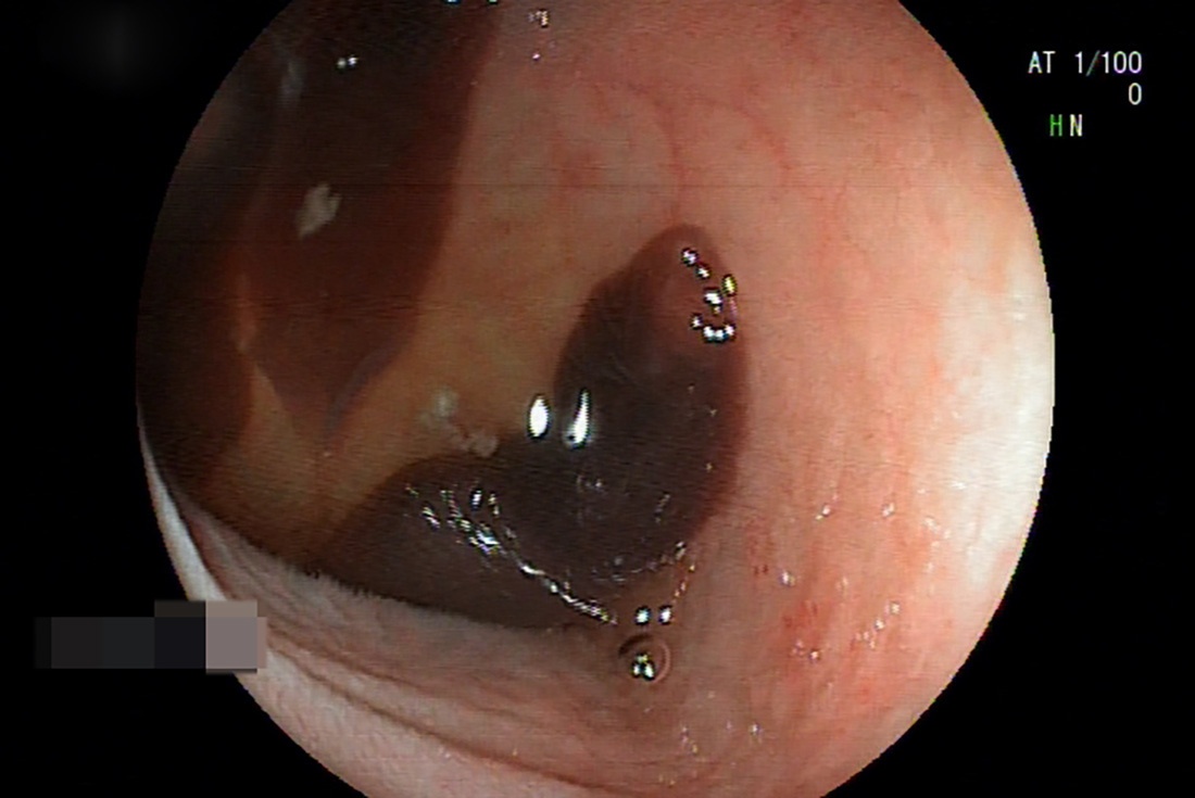 Bac si phat hien o san lon trong ruot benh nhan hinh anh