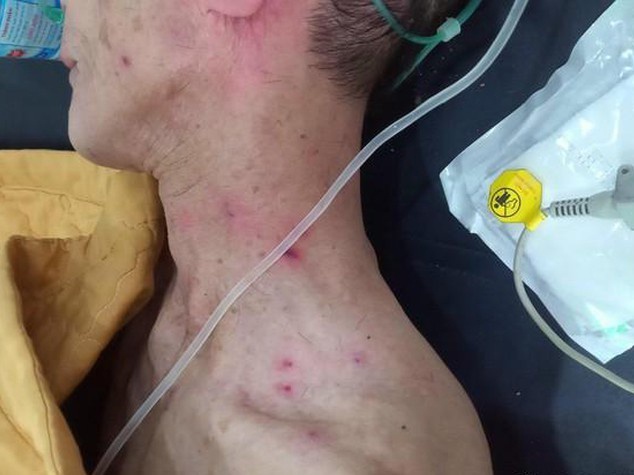 Hai cha con bi ong dot phai nhap vien cap cuu hinh anh