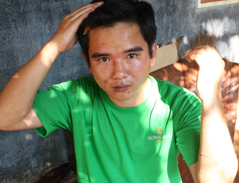 Thieu uy cong an bi to danh dong nghiep nhap vien hinh anh
