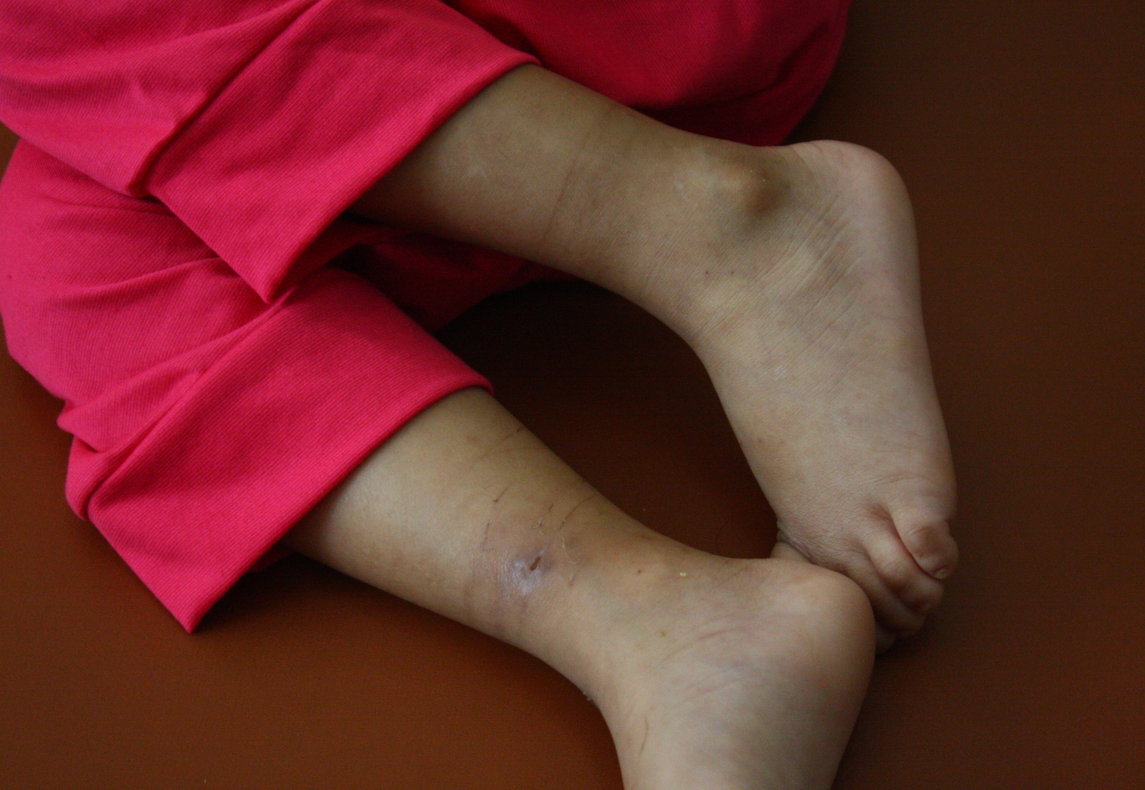 Hai chân của đứa trẻ vẫn hằn vết tím khi bị trói.