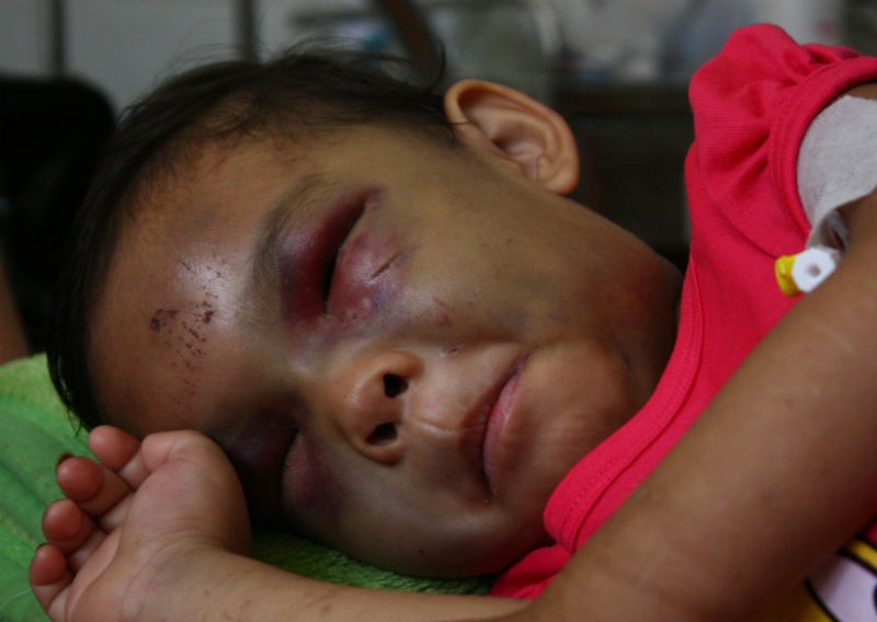Hai mắt của đứa bé bị ba mẹ đánh sưng tím hết mặt mũi.