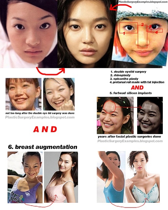 Shin Min Ah nổi tiếng là sao nữ gợi cảm của Hàn Quốc và vẻ đẹp tự nhiên. Nưng  những hình ảnh so sánh cho thấy, Min Ah đã thẩm mx khá nhiều: chỉnh mắt để có mắt  hai mí rõ nét hơn, chỉnh mũi, chỉnh trán, nâng ngực