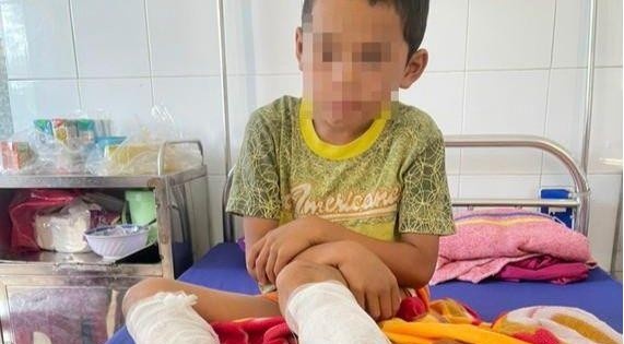 Chau be lop 3 bi cha dung xang va rom dot hai chan hinh anh