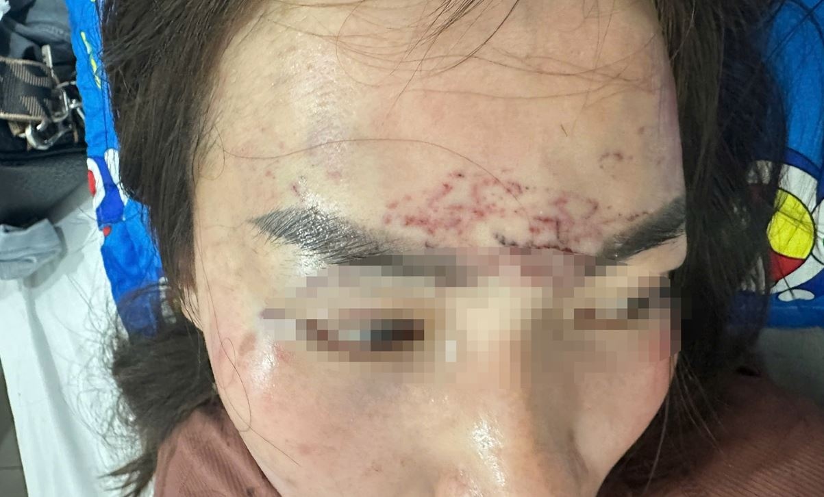 Nguoi phu nu bi keo len oto, ‘tra tan’ bang axit va may xam o Ca Mau hinh anh