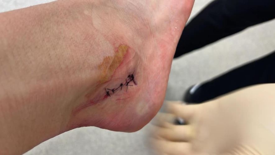 Dalot rach mat ca anh 1