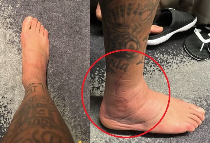 Neymar chan thuong anh 1