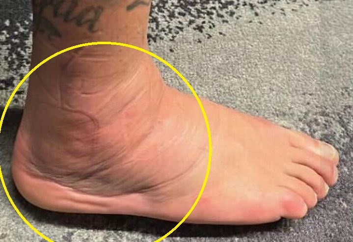 Mat ca chan bat thuong cua Neymar hinh anh