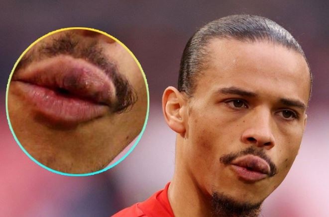 Moi cua Sane sau khi bi Mane dam hinh anh