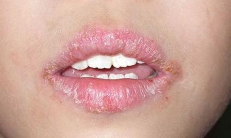 Ly giai vet nut noi khoe mieng hinh anh