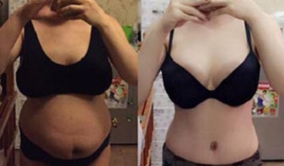 9X phau thuat cat 5 kg mo vung bung sau 2 lan sinh hinh anh