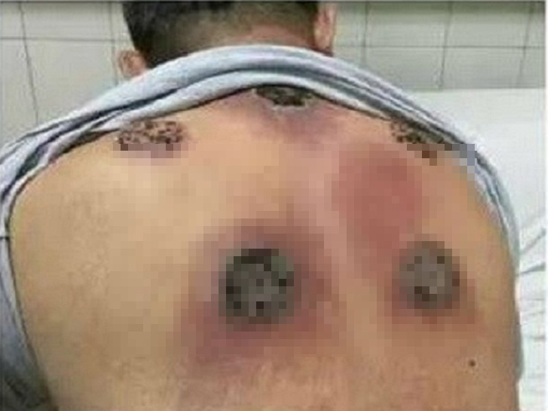 Nhap vien vi nhiem trung do giac hoi lien tuc mot thang hinh anh