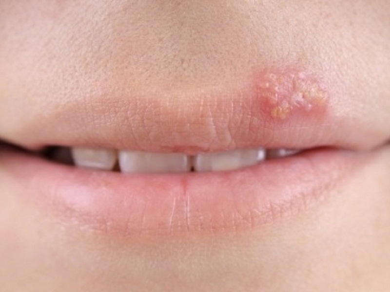 Cach dieu tri benh zona o mat hinh anh