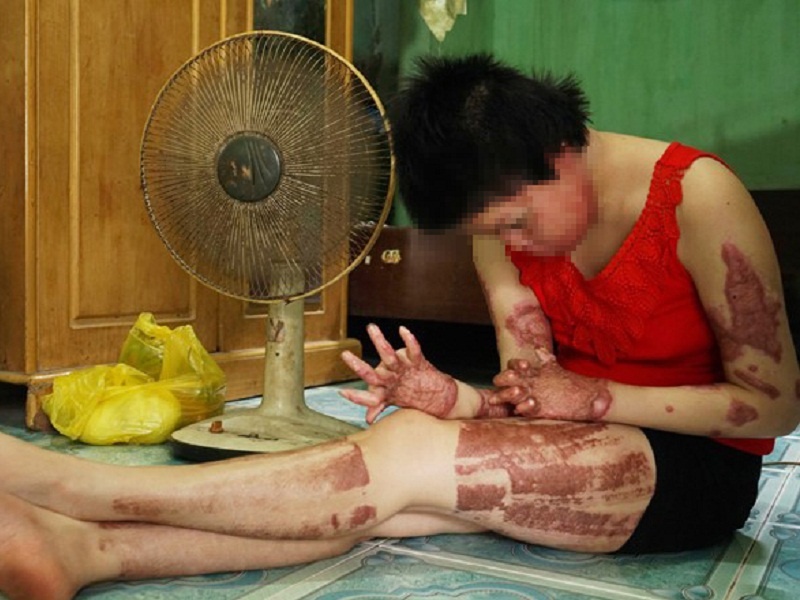 Bong xang nguy hiem nhu the nao? hinh anh