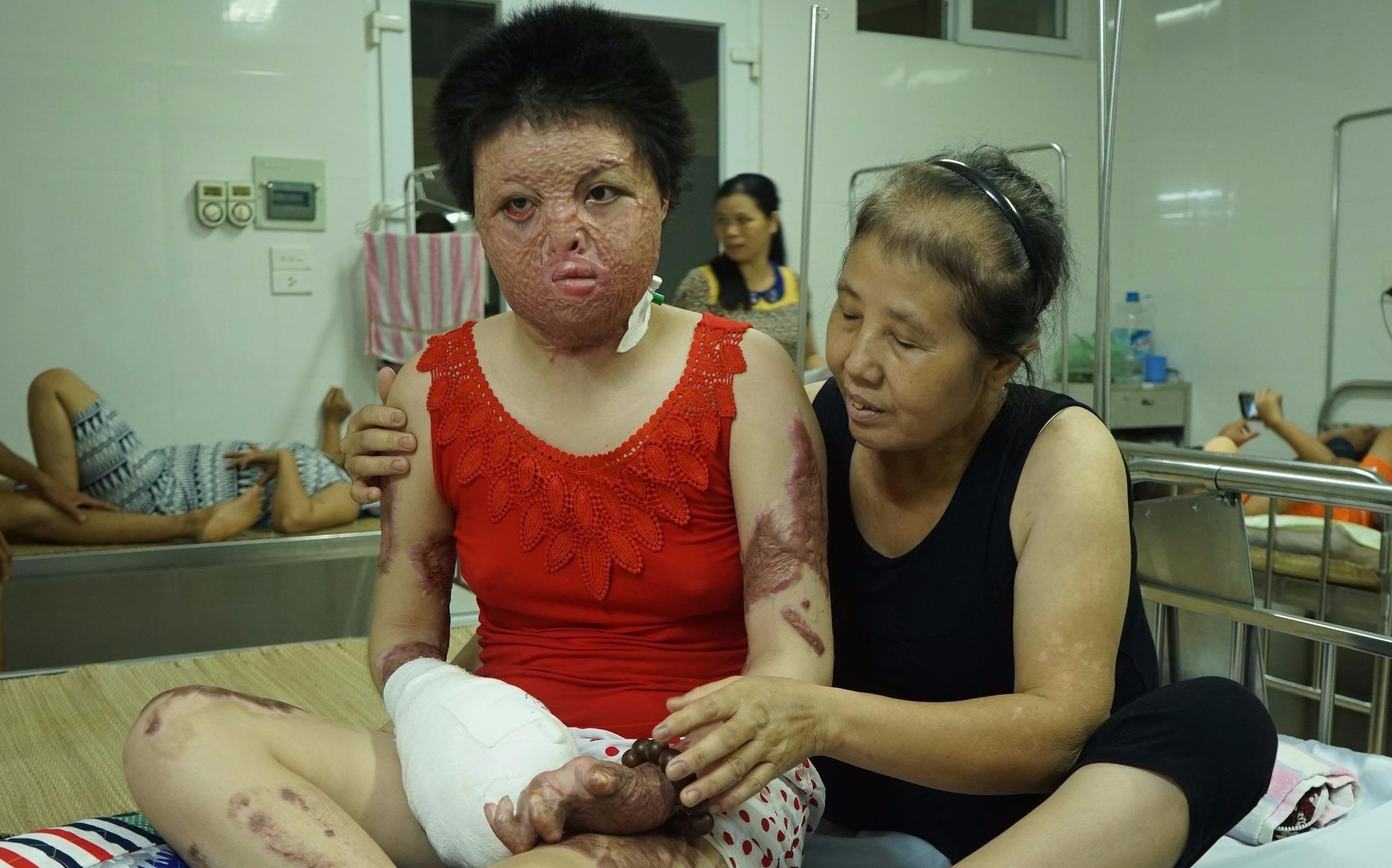 Co gai bi chong tuoi xang dot phau thuat mo rong mieng hinh anh