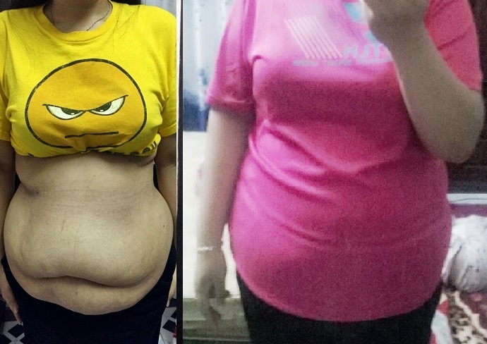 Thụy Phương sau 10 lần phẫu thuật giảm 45 kg ảnh 1 Thuy Phuong sau 10 lan phau thuat giam 45 kg anh 1