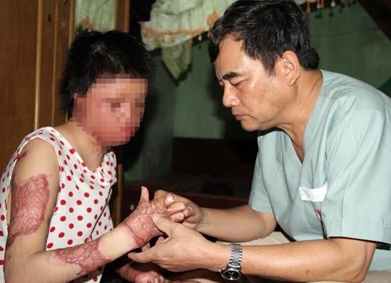 Phau thuat hoan thien doi tay co gai bi chong tuoi xang dot hinh anh