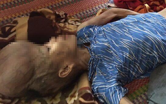 Nguoi phu nu nang 20 kg mang khoi u hon 4 kg tren dau hinh anh