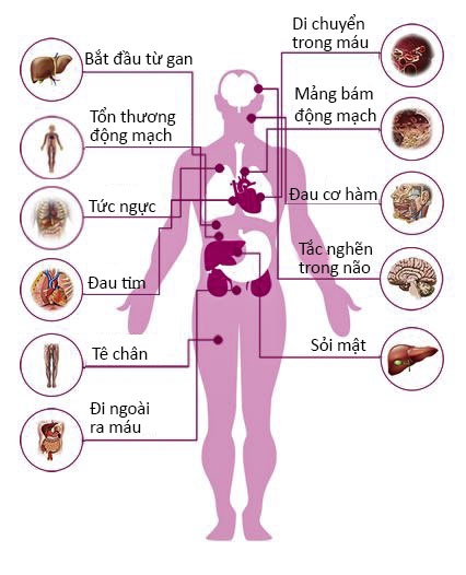 Bệnh tim do cholesteron cao ảnh 1 Benh tim do cholesteron cao anh 1