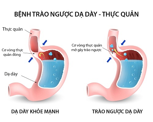ngăn ngừa trào ngược axit và ợ nóng ảnh 1 ngan ngua trao nguoc axit va o nong anh 1