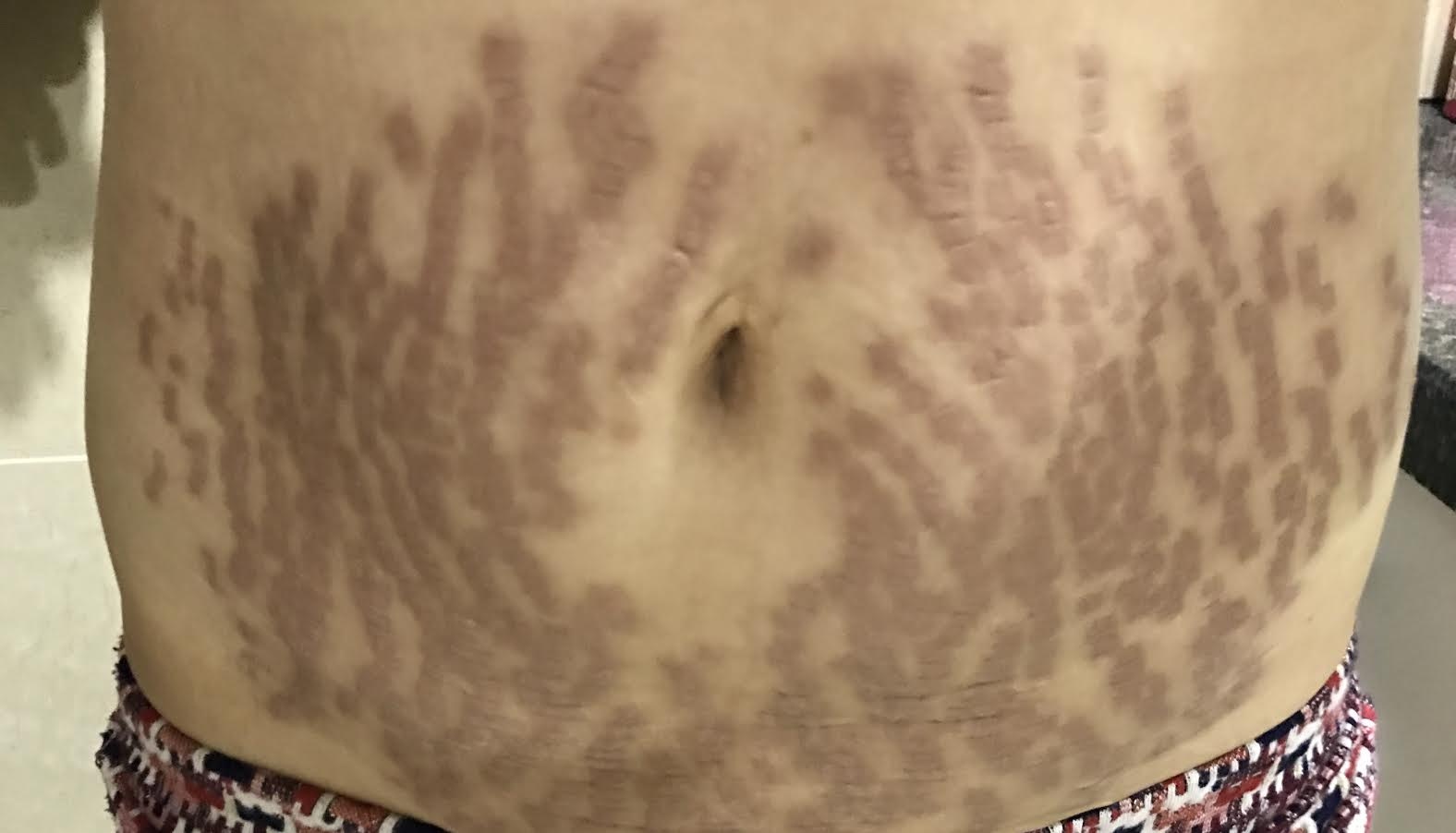 phau thuat tham my,  tham my,  tao hinh vung bung anh 1