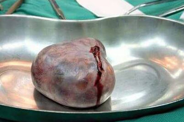 Mac u nao hiem gap, nu sinh 18 tuoi duoc cuu song sau 5 thang nam vien hinh anh