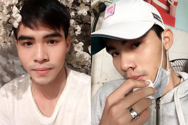 nâng mũi,  phẫu thuật thẩm mỹ ảnh 1 nang mui,  phau thuat tham my anh 1