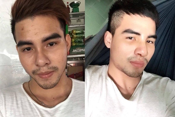 nâng mũi,  phẫu thuật thẩm mỹ ảnh 2 nang mui,  phau thuat tham my anh 2