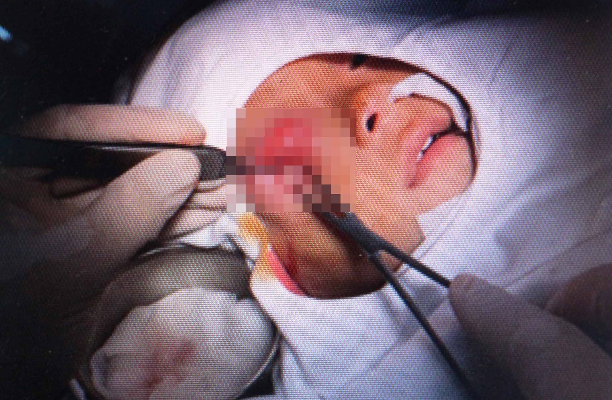 Be 16 thang tuoi suyt mu vi bien chung do viem xoang hinh anh